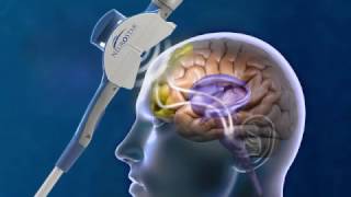 How Does Transcranial Magnetic Stimulation work [upl. by Yert]