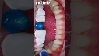 Cementación de CORONA sobre IMPLANTE dental✨🦷 [upl. by Ynnahc]