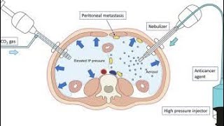 Intraperitoneal Route of Drug Administration [upl. by Giles893]