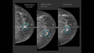 Diagnostic mammography [upl. by Dranel]