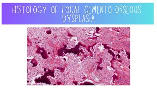 Histology of Focal CementoOsseous Dysplasia [upl. by Trey]