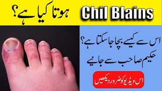 Chilblains Treatment  Swollen hands and fingers in winter  By Hakeem ObaidurRehman [upl. by Ititrefen]