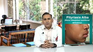 Vitiligo Symptoms Causes Types amp Management I Dr Amit Vij [upl. by Emerick]