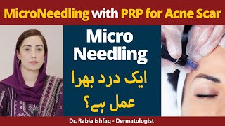 Microneedling With PRP For Acne Scars  Is It Painful Procedure  Microneedling Kya Hota Hai [upl. by Reehsab]