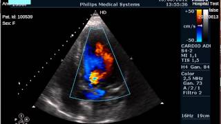 Viewing a cardiac ultrasound doppler Dicom multiframe on medview [upl. by Bellew890]