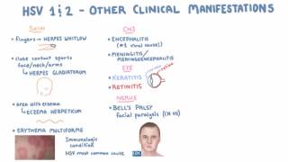 HSV  Clinical Presentation  Part 2 [upl. by Othilia857]