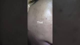 My acne journey for more times clindacin plus jelshortsvideo [upl. by Jamill]