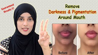 How to Remove Dark Upper Lips  Black patches Dark Spots Hyper pigmentation around Mouth [upl. by Nonnerb]