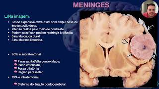 TUMORES DO SISTEMA NERVOSO CENTRAL [upl. by Ernesta]