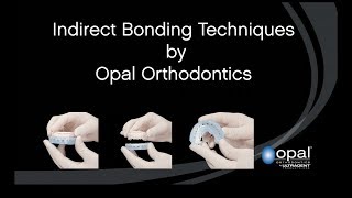 Indirect Bonding by Opal Orthodontics [upl. by Octavian456]