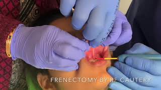 Frenectomy by RF Cautery by Dr Keval Patel at J K DENTAL HOSPITAL Ahmedabad [upl. by Elton]