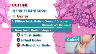 Goiter Graves disease multinodular goiter Thyroid lecture شرح محاضرة [upl. by Ondrej163]