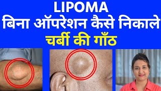 चर्बी की गाँठ  LIPOMA  को बिना ऑपरेशन कैसे निकाले । LIPOMA homeopathic treatment [upl. by Photina831]