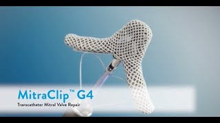 Transcatheter EdgetoEdge Repair with MitraClip™ G4 [upl. by Eugilegna]