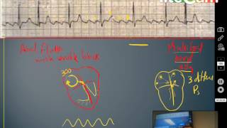 scheme for Arrhythmia ECG [upl. by Arahsak]