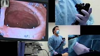 Situs inversus Total colonoscopy [upl. by Wiebmer711]