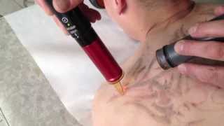 Tattoo removal  enlever les tatouages au laser Candela AlexTriVantage [upl. by Lokkin350]