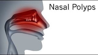 How To Get Rid of Nasal Polyps [upl. by Vern]