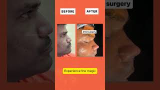 Patient from Chennai  Nose Surgery Results  Before amp After  Dr Mathew PC shorts [upl. by Utimer716]