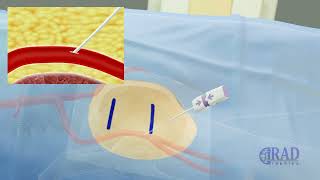 Active arterial access closure device Angioseal [upl. by Aliakim]