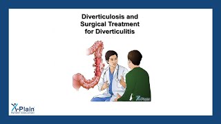 Diverticulosis and Surgical Treatment for Diverticulitis [upl. by Eyahc390]