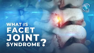 What is Facet Joint Syndrome [upl. by Muryh]