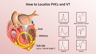 Advanced EKGs  Ventricular Tachycardia Classification amp Localization [upl. by Hsara]