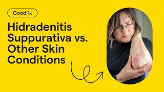 Hidradenitis Suppurativa vs Other Skin Conditions How to Tell the Difference  GoodRx [upl. by Sirc]