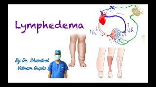 Lymphedema for MBBS MS Surgery medical students [upl. by Annal]