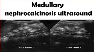 Medullary nephrocalcinosis Ultrasound [upl. by Linders]