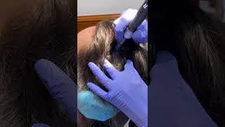 Microneedling for hair loss for scalp PRP microneedling hairlosstreatment [upl. by Llenrep839]