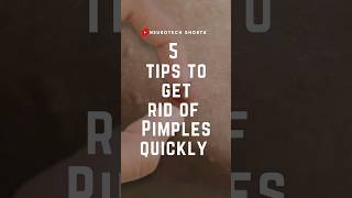 How to get rid of pimples  tips [upl. by Acissaj962]