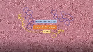 Urine of UTI patient under the Microscope [upl. by Glassman246]