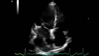 Thrombus in the left atrium  Transthoracic Echocardiogram TTE [upl. by Hannavas319]