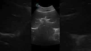 Pneumobilia post ERCP with stent Apache [upl. by Acherman]