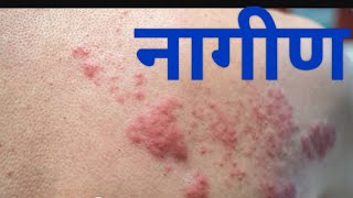 herpes zoster shingles  causes mythstreatment [upl. by Gristede]