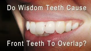 Do Wisdom Teeth Cause Front Teeth To Overlap and Get Crowded [upl. by Fenwick]