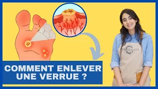 Comment enlever les verrues naturellement   HPV Causes symptômes prévention et solutions [upl. by Ainnos]