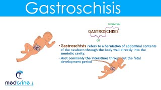 Gastroschisis Definition Causes and Diferences with Omphalocele [upl. by Egdirdle]