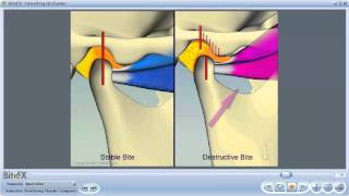 TMJ Disorders [upl. by Suoilenroc962]