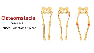 What is osteomalacia [upl. by Yadahs324]