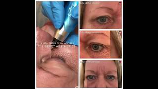 PlasmaPro Treatment to Lower Eye Area aka Plasma Blast  Fibroblast  Plexr [upl. by Airdnazxela]