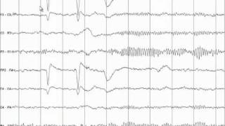 EEG Tutorial [upl. by Lindner691]