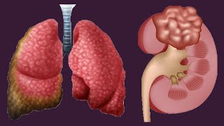 Low And High Hematocrit Levels Causes And Symptoms [upl. by Affay]