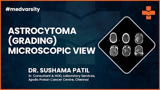 Understanding Astrocytoma Grading Microscopic View  Medical Case Discussion [upl. by Hill179]