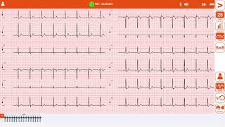 Acquisizione tracciato Ecg con elettrocardiografo Cardioline touch Ecg HD Plus [upl. by Andreana]