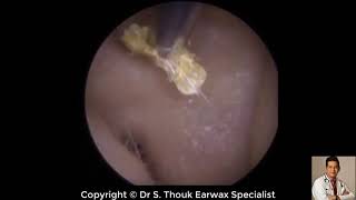 Top Biggest Ear Wax Removal 84  Ear wax Extraction  Dr S Thouk Earwax Specialist [upl. by Erdried]