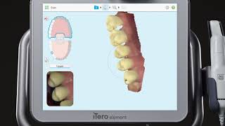 iTero® Scanner Tutorial Charting and Scanning for an Implant [upl. by Arvind660]