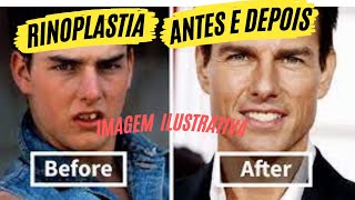 rinoplastia antes e depois [upl. by Nosyd385]