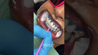 teeth whitening transformation 🦷 teethwhitening torontoteethwhitening [upl. by Ilam]